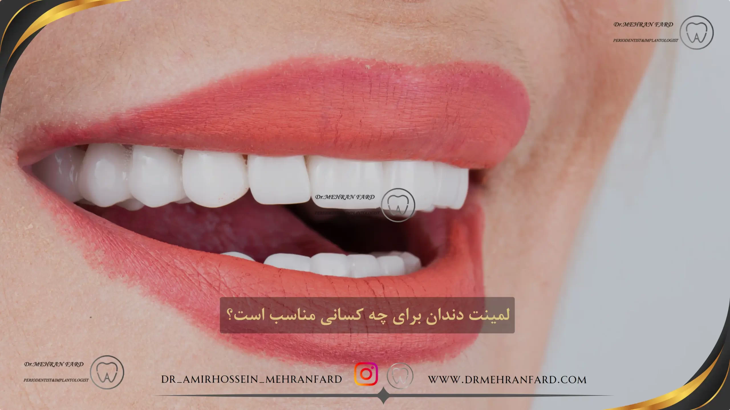 لمینت دندان برای چه کسانی مناسب است؟