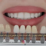 ✨راهنمای انتخاب بهترین رنگ لمینت دندان🦷|طبیعی‌ ترین رنگ لمینت دندان